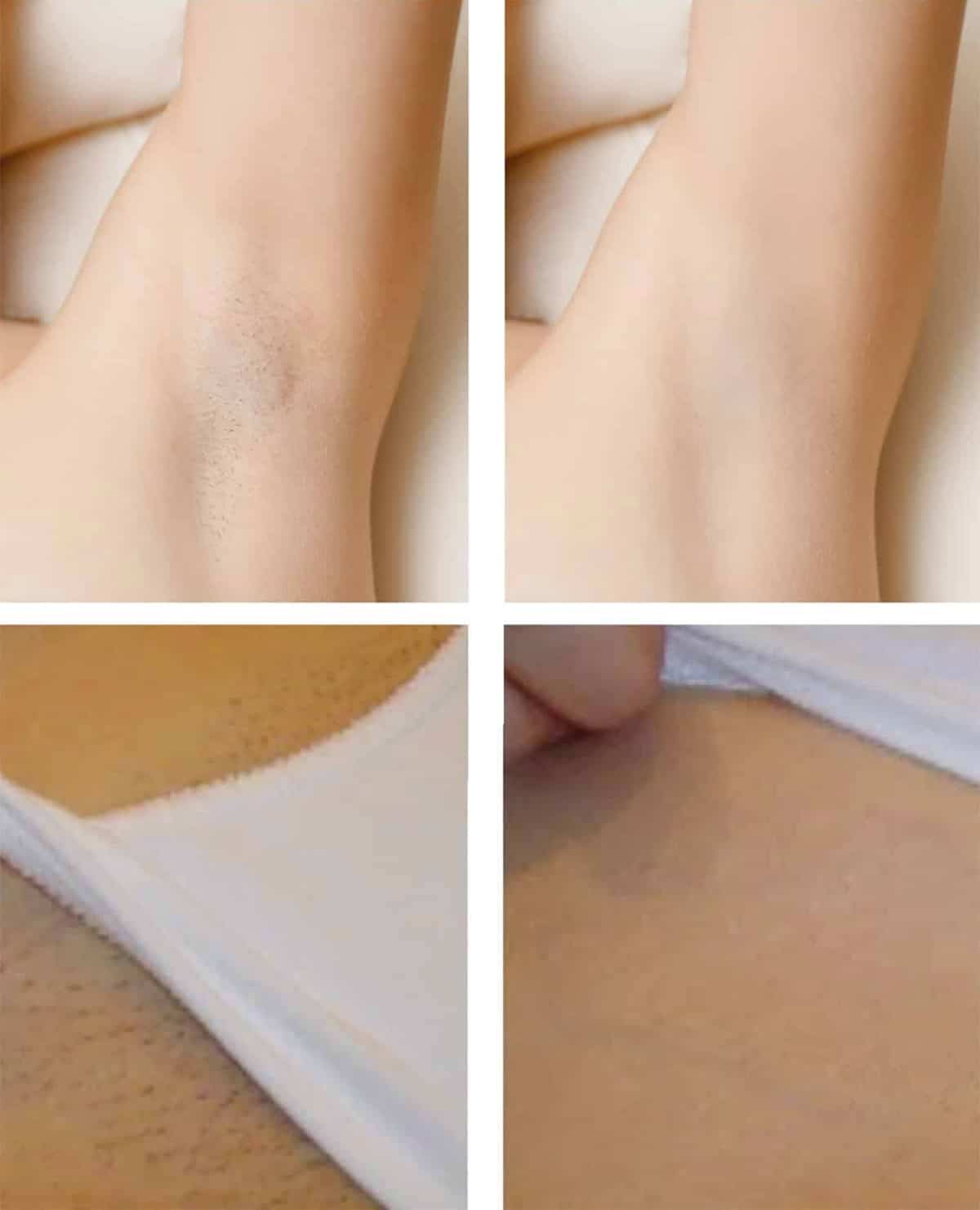 amazing result from Laser hair Removal vancouver
