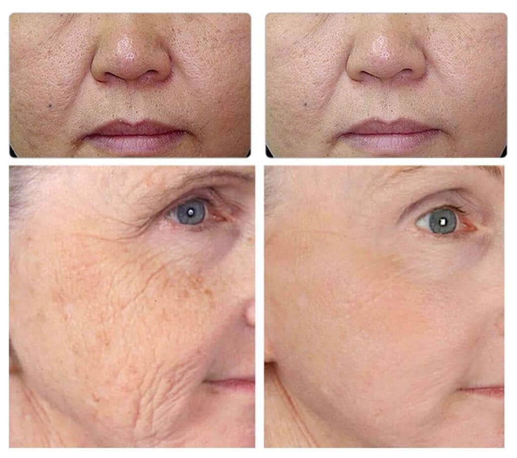 Pixel RF Skin Tightening in Vancouver Arion Skin Laser Clinic