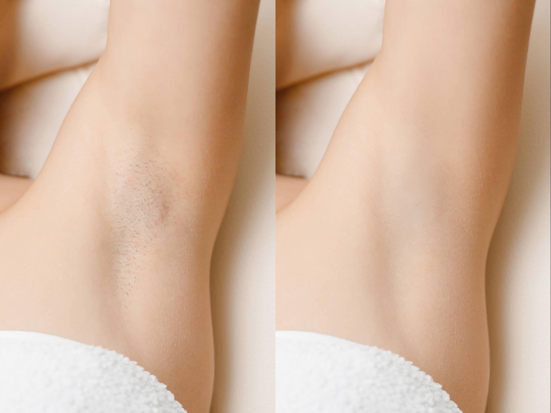 Laser Hair Removal Vancouver3