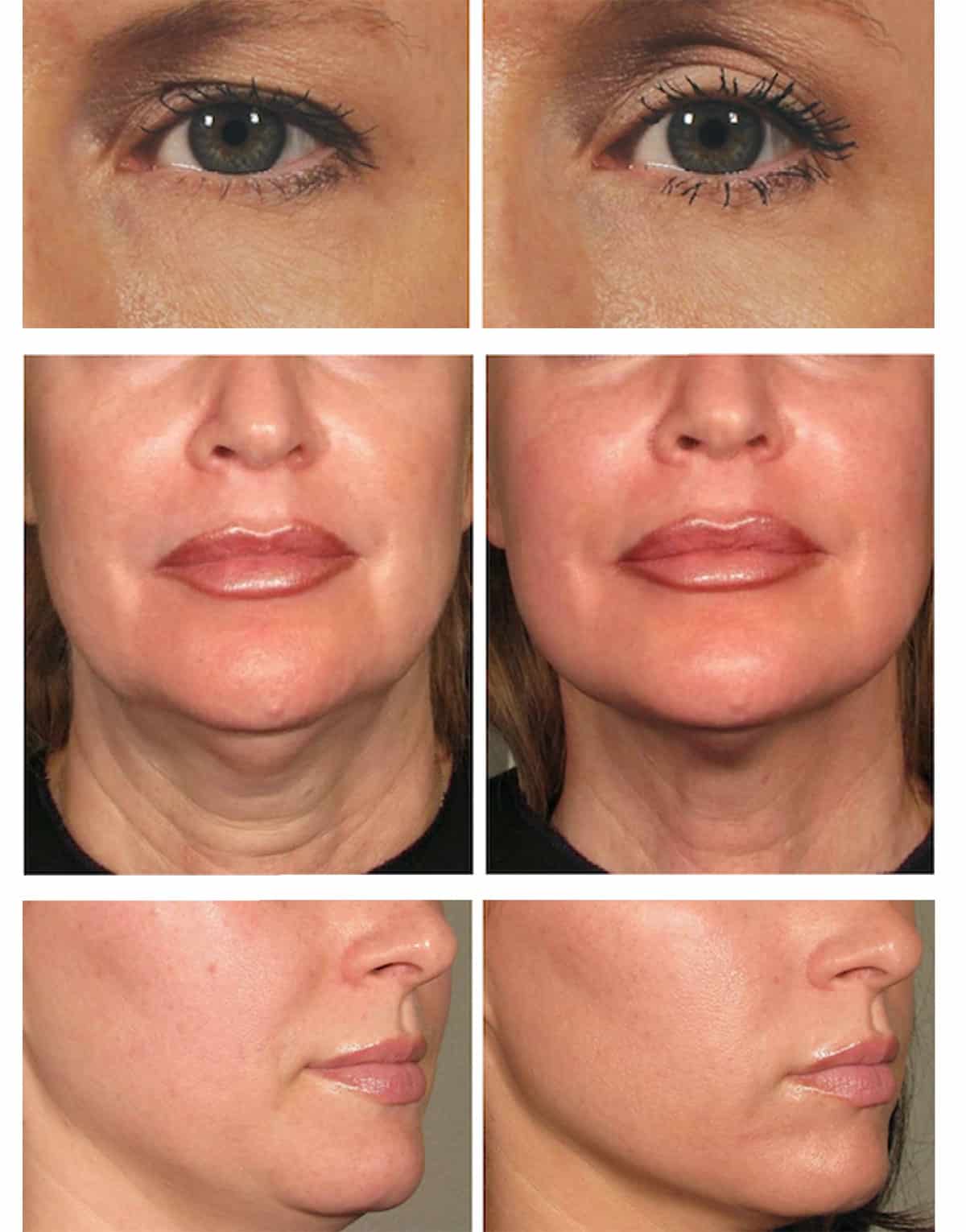 Non-Surgical Face Lift in Vancouver