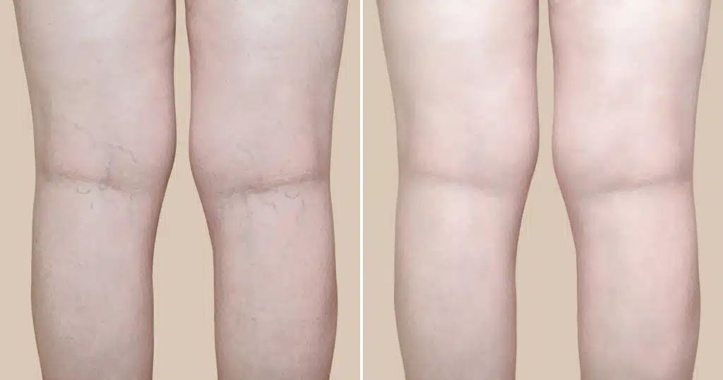 Sclerotherapy vs. Surgery