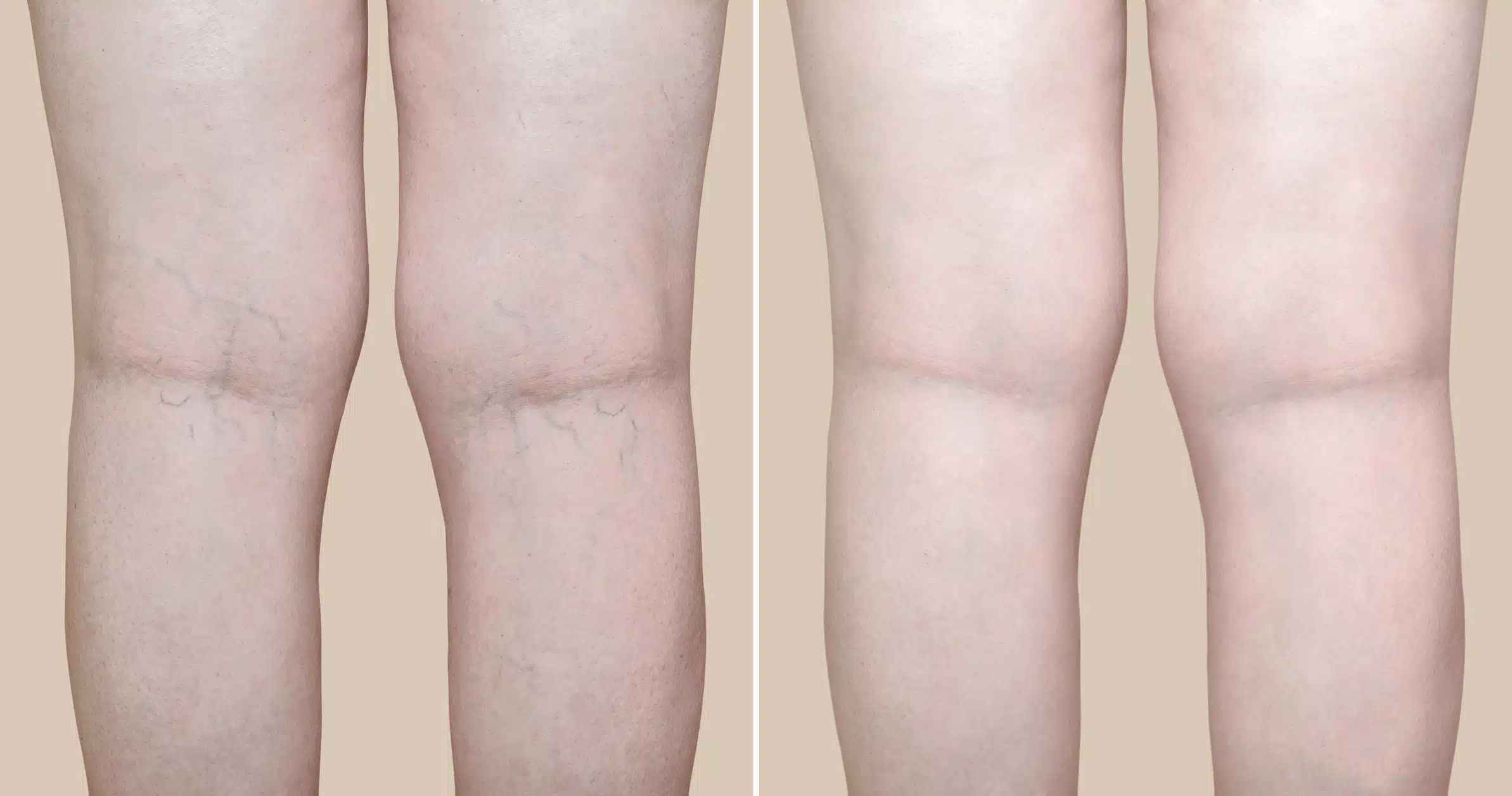 Sclerotherapy vs. Surgery