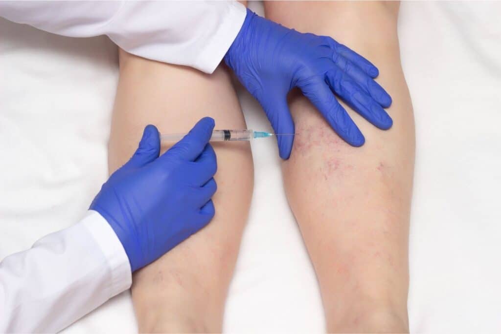 Sclerotherapy vs. Surgery 